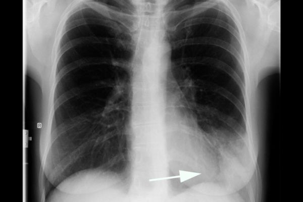 Lungenentzündung in der Thoraxübersicht