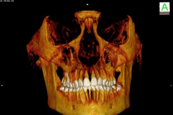 Zahndiagnostik vor Korrektureingriff;Rekonstruktionsmodus Volume Rendering