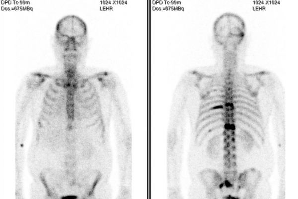 Skelettzintigraphie mit Hot Spots durch Knochenmetastasen